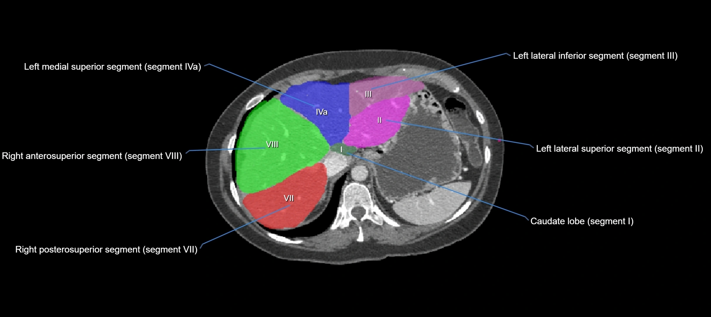 CT liver segments axial cross sectional anatomy labelled image-00058.webp